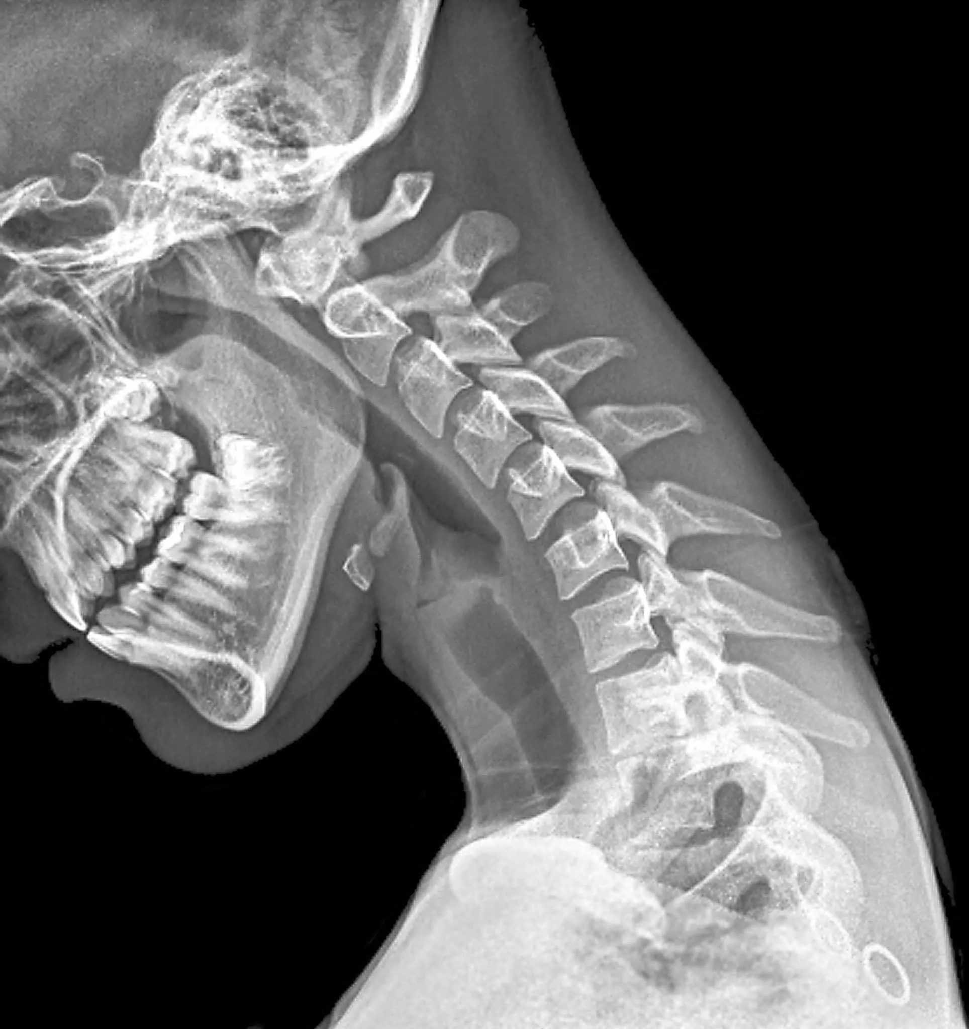 Cervical spine X-ray showing detailed bone structure