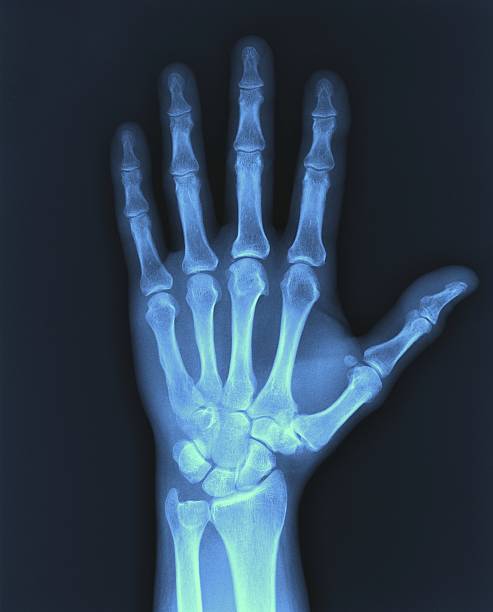 X-ray image of a hand showing bone structure detail