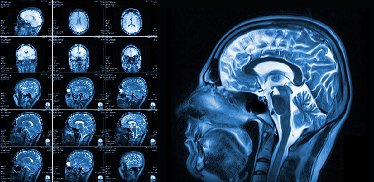 MRI Brain scan report showing multiple diagnostic views